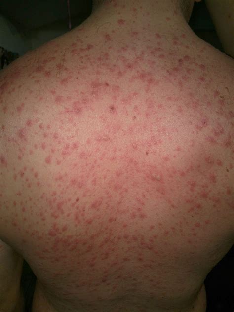 Steven Johnson Syndrome Early Signs Stevens Johnson Syndrome