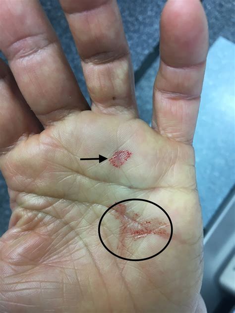 Management of diabetic trigger finger: surgical release under WALANT | Published in Journal of ...