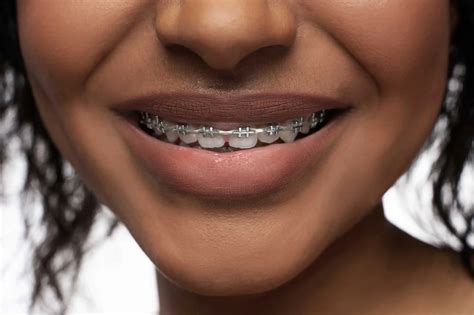 Does Medicaid Cover Braces? Learn About Your Benefits - Dentaly.org