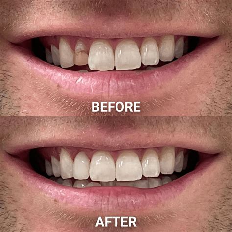 Veneers Quiz | Adelaide Cosmetic Dentistry