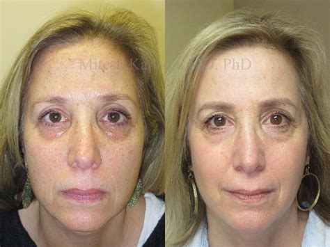 Before and after after CO2 laser skin resurfacing, two treatments | Boston Eyelid Surgery