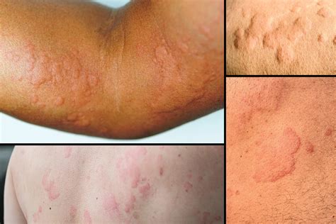 Surprising Causes Of Hives Revealed — What May Be Triggering Your Skin Reaction