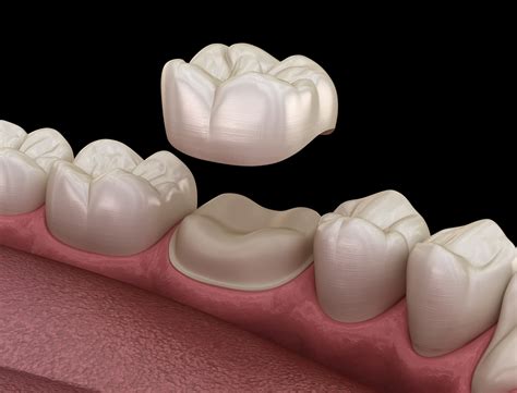 Dental Implant vs. Crown: Which is the Right Choice for You? - Hanna ...