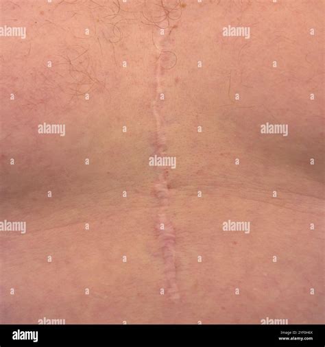 Scar from open heart surgery on white man, where the sternum was cut in ...