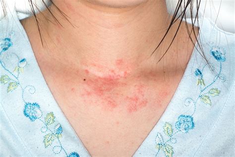 What Causes Itchy Rash On Chest And Back at Jennifer Marshall blog