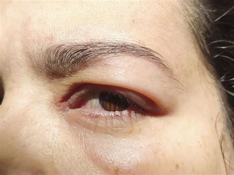 How To Treat Swollen Eyes From Allergies