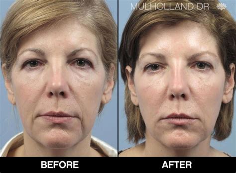 Fractionated Co2 Laser CO2 Laser Skin Resurfacing With Sculptra Facial