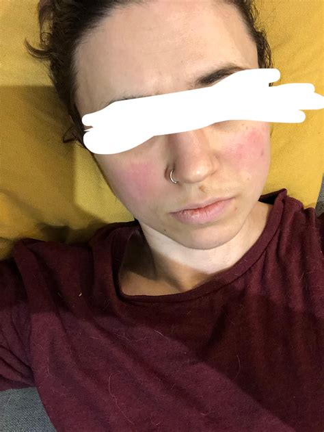 Malar rash/flush: chronic disease alternatives to lupus? (Likely not something like rosacea in ...