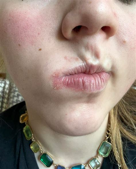 How to Soothe and Heal Eczema Around Your Lips: Expert Tips That Actually Work
