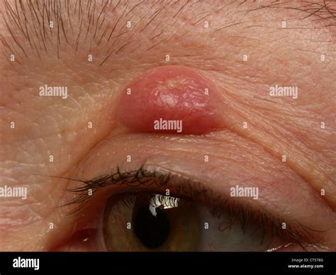 Eyelid cyst hi-res stock photography and images - Alamy