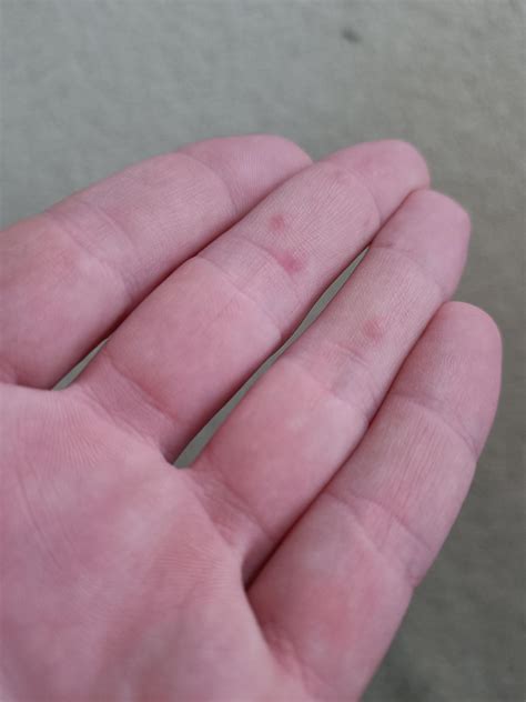 Why Do I Have Painful Bumps On My Hands at Melissa Dunphy blog