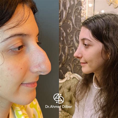 Rhinoplasty Result | Büyük burunlar, Saç, Cerrahi