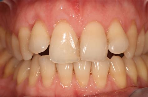 Gum Recession Due To Orthodontic Treatment at Koby Rawling blog