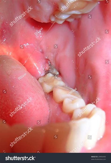 Wisdom Teeth Blood Clot