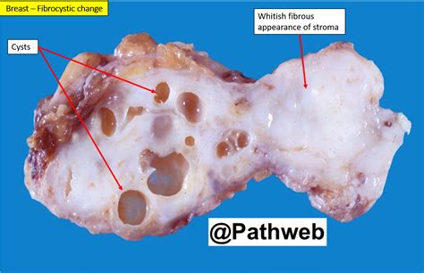 Breast – Fibrocystic Disease – NUS Pathweb :: NUS Pathweb