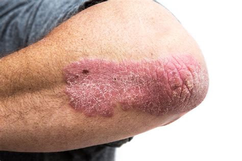 Dermatologist For Psoriasis Hertfordshire | Medi-Derm Clinic