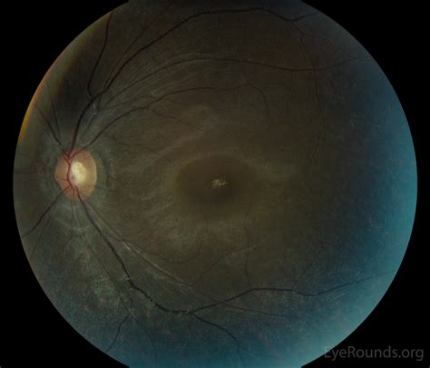 Bull's-eye maculopathy due to hydroxychloroquine toxicity
