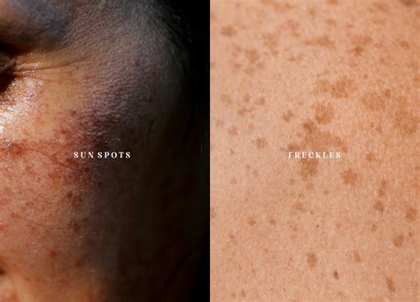 Pico Laser: Is It Right for Sun Spots or Freckles?