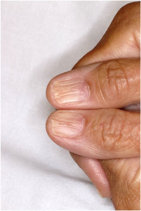 Dermatology images: Lichen planus - Journal of the American Academy of ...