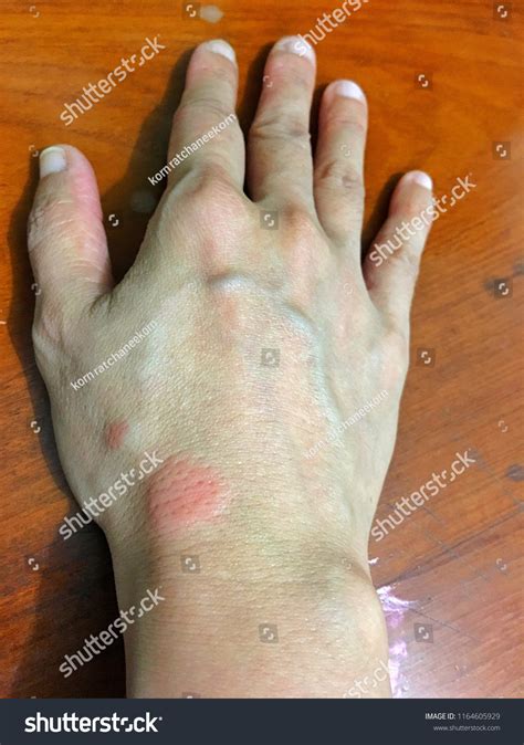 202 Red Lupus Patient Images, Stock Photos & Vectors | Shutterstock
