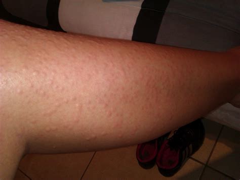 How To Get Rid Of Waxing Rash - Sonmixture11