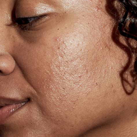 Blackhead On Face Inflamed Acne: Cystic Acne And Other Types, Plus How