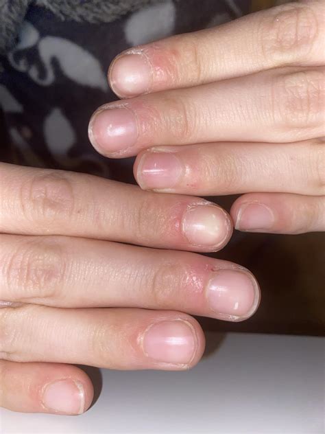 Rough Dry Fingernails