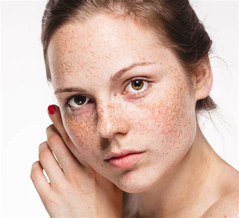 Treating Freckles, Skin Conditions & Skin Concerns
