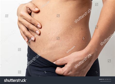 613 Stretch Marks After Pregnancy Images, Stock Photos & Vectors ...