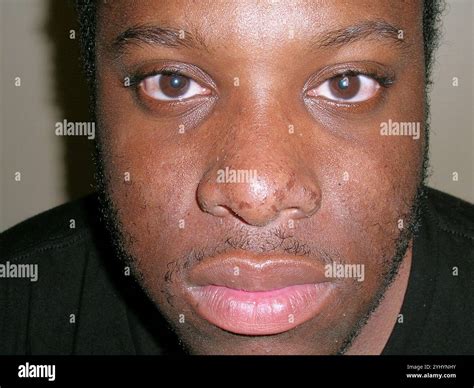 Oily skin, or seborrhoea, on the face of an African-American male patient. This condition is ...