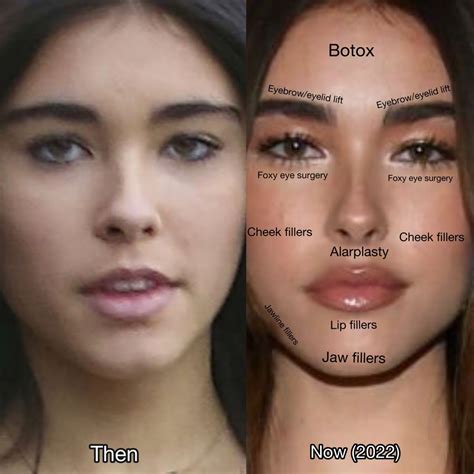 Madison Beer plastic surgery and enhancements in 2025 | Botox before and after, Madison beer ...