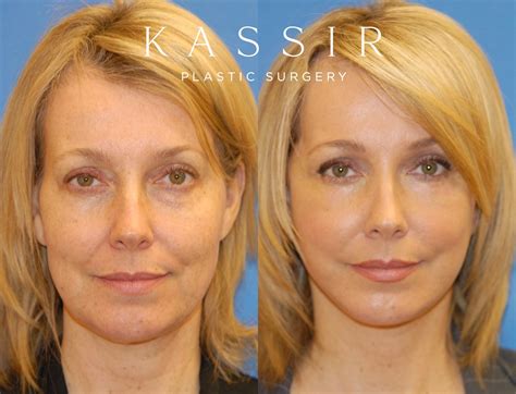 What is the perfect age for a face lift ? — Kassir Plastic Surgery in NY and NJ