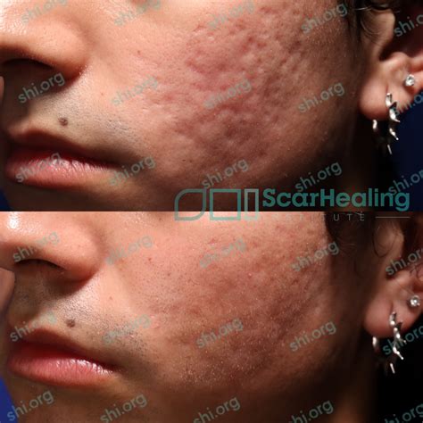 Scar Healing Institute: 2024 Leading Pioneers of Scar Treatment ...