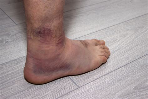 Ankle sprain | NHS inform
