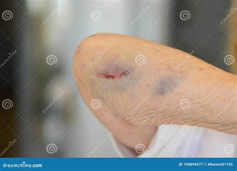Elderly 80-year Old Woman with Fractured Elbow Stock Image - Image of ...