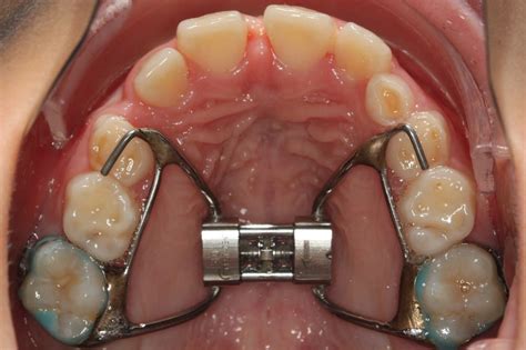 Orthodontic Expanders Are The First Step To Staighter Teeth - Schulfotograf
