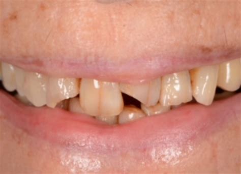 Gum Abscess Popped? Thinking of Popping It Yourself?