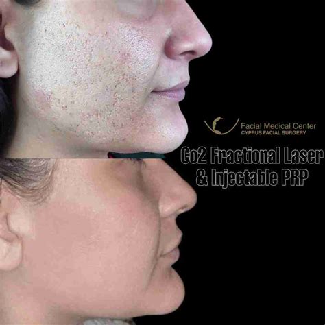 Fractional Laser CO2 Laser Skin Resurfacing Glasgow | Fractional CO2