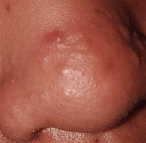 [Acne] I'm 16 and I've been wondering what these bumps on my nose are, they aren't pimples, no ...
