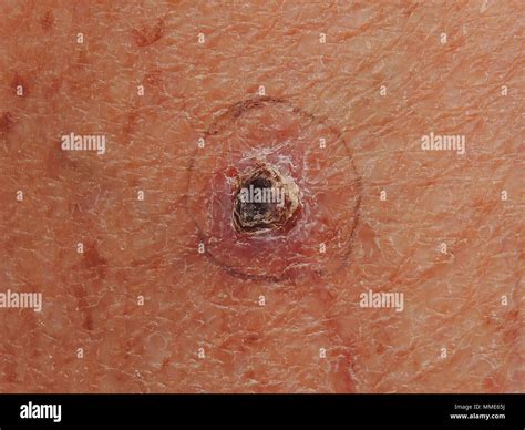 Basal cell carcinoma: hi-res stock photography and images - Alamy