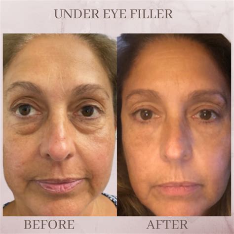 Under Eye Filler - Eluma - Laser & Aesthetics