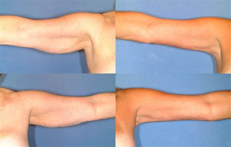 Arm Lift in Louisville & Lexington, KY | CaloAesthetics® Plastic Surgery Center