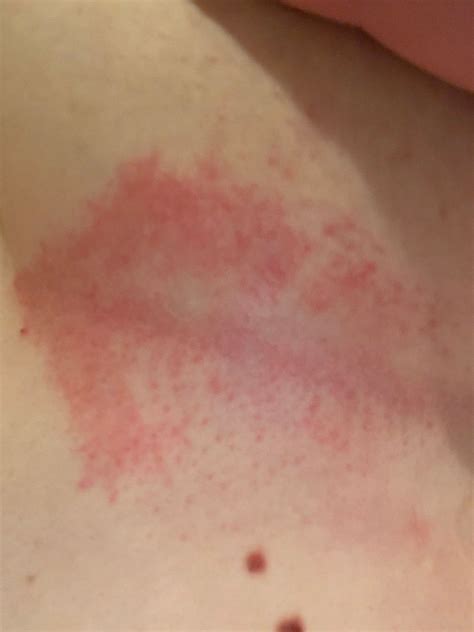 Rash Under Breast Heat Yeast Infection Itching Hidradenitis