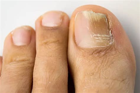 Causes and Treatments of Toenail Fungus | LifeMD