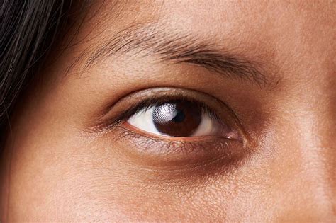 What Causes Dark Circles Around The Eyes