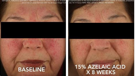 Doctor’s Note: Your Easy + Essential Guide to Azelaic Acid