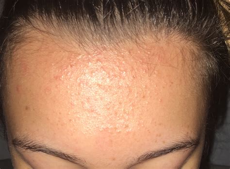 Forehead Bumps Fungal : Folliculitis On Forehead Causes: Symptoms And Treatment Options – ICKAH