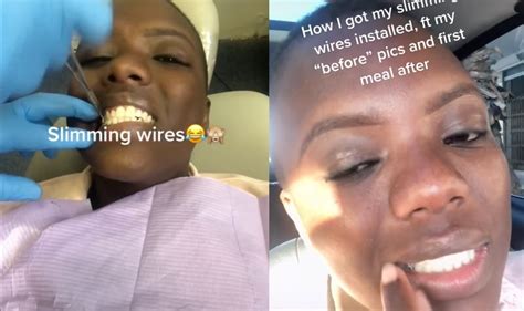 Woman Wires Her Mouth Shut To Reportedly Lose Weight • Hollywood Unlocked