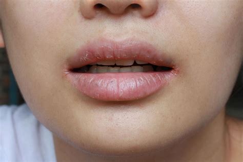 Chapped Lips: Causes & Ways to Treat Dry, Cracked Lips