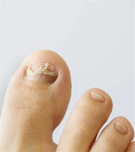 How To Treat And Prevent Ingrown Toenail In Babies?